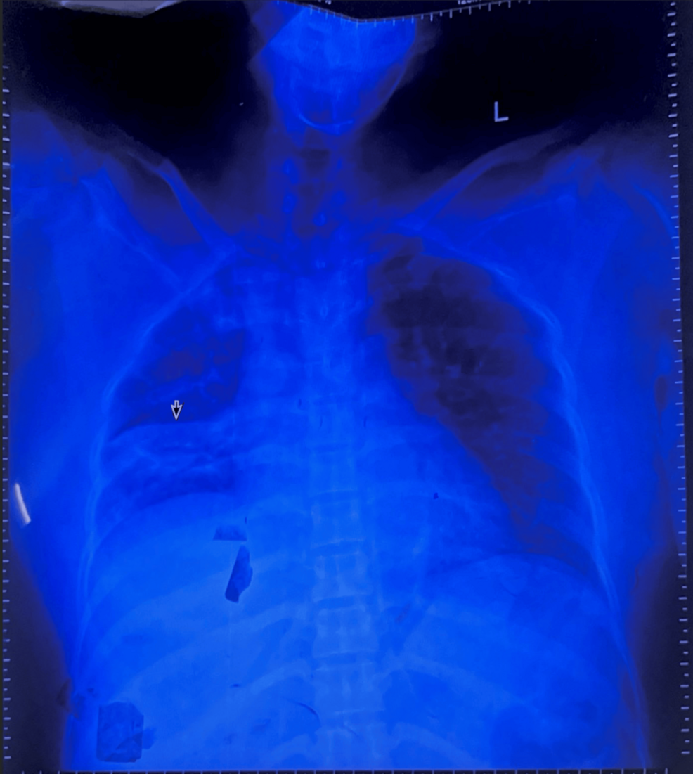 Atypical Acute Motor Axonal Neuropathy (AMAN) Presenting Concurrently With Community-Acquired Pneumonia and Respiratory Failure: A Case Report