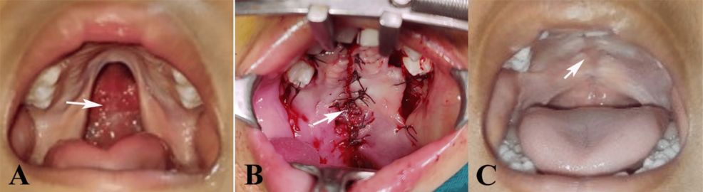 Comparative Outcomes of Conventional Bardach Two-Flap Palatoplasty Versus  Modified Alveolar Ridge/Crevicular Incision Technique in Isolated Cleft  Palate Repair: A Prospective Observational Study