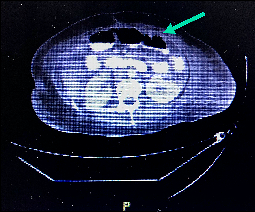 Cureus | Disseminated Mycobacterium Avium Intracellulare Infection With ...