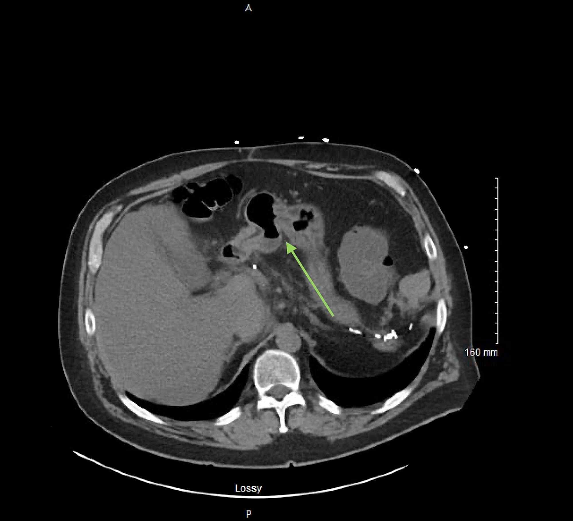 Fistula In Abdomen