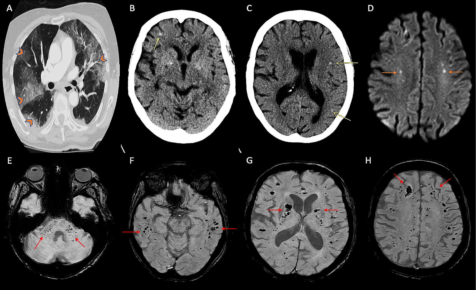 Cureus COVID 19 Related Acute Hemorrhagic Necrotizing Encephalitis A Report Of Two Cases And 