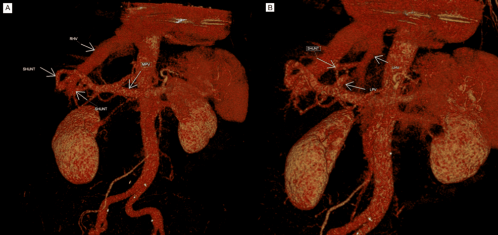 A Mysterious Case of Recurrent Confusion: An Unusual Presentation of Congenital Intrahepatic Portosystemic Shunt