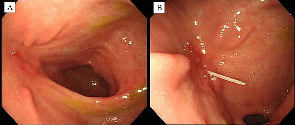 PADLOCK CLIP™ Defect Closure System - Closure of colonoscopy