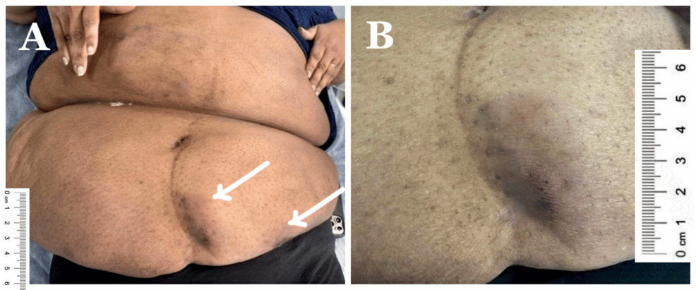 tirzepatide components Tirzepatide for Weight Loss