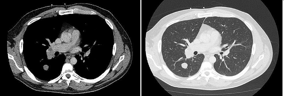 CT-scan-of-the-lung-with-contrast-showing-right-hilar-lymph-node-and-right-upper-lobe-mass