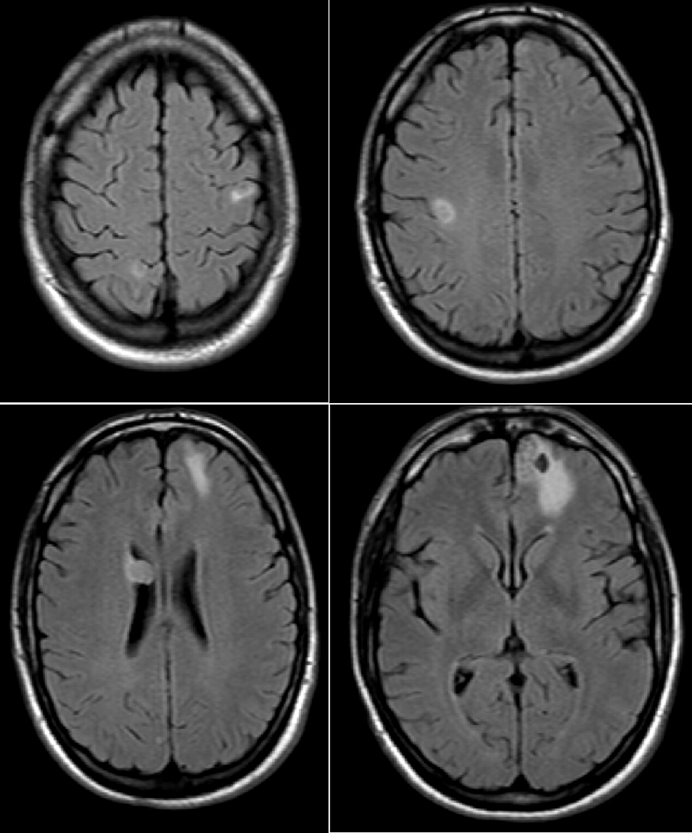 MRI-brain-with-and-without-contrast-showing-multiple-brain-metastases