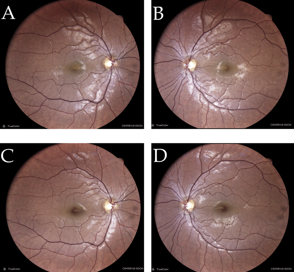 A Case of Bilateral Macular Phototoxicity and the Role of Multimodal  Imaging | Cureus