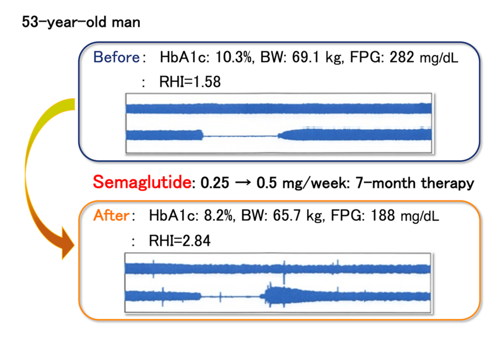 semaglutide heart rate reddit Once-Weekly Semaglutide Is Associated With Improvement in Vascular  Endothelial Function in Patients With Type 2 Diabetes Mellitus: A  Retrospective Observational Study
