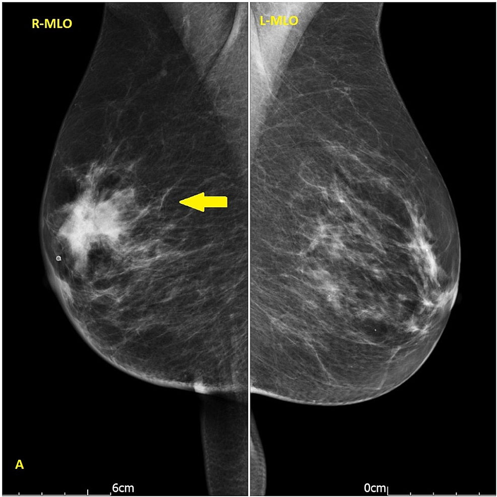 Mammography-mediolateral-oblique-(MLO)-view-showed-a-soft-tissue-density-in-the-right-breast-with-speculated-margins-measured-42x30-mm-(yellow-arrow)
