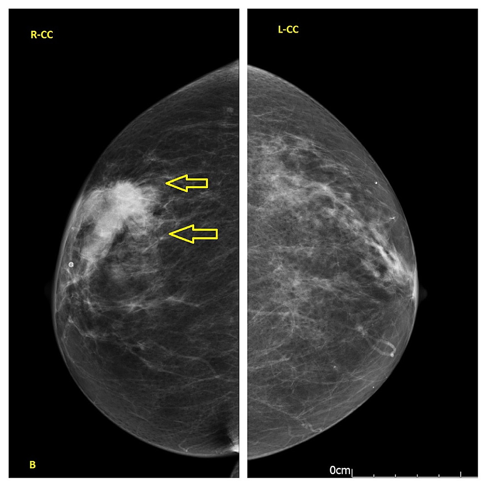 Craniocaudal-(CC)-view-showed-a-soft-tissue-density-in-the-right-breast-with-speculated-margins-measured-42x30-mm-(yellow-arrow).