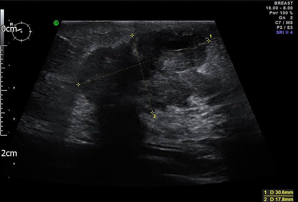 Ultrasound-right-breast-reported-a-speculated-diffuse-hypoecoic-lesion-in-the-right-breast-lower-outer-quadrant-with-an-appearance-suggestive-of-a-neoplastic-lesion