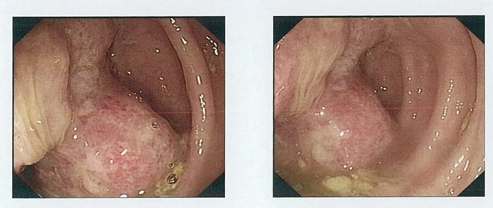 Colonoscopy-demonstrating-a-distal-ascending-colon-malignant-looking-sessile-polyp,-50-mm-in-diameter.
