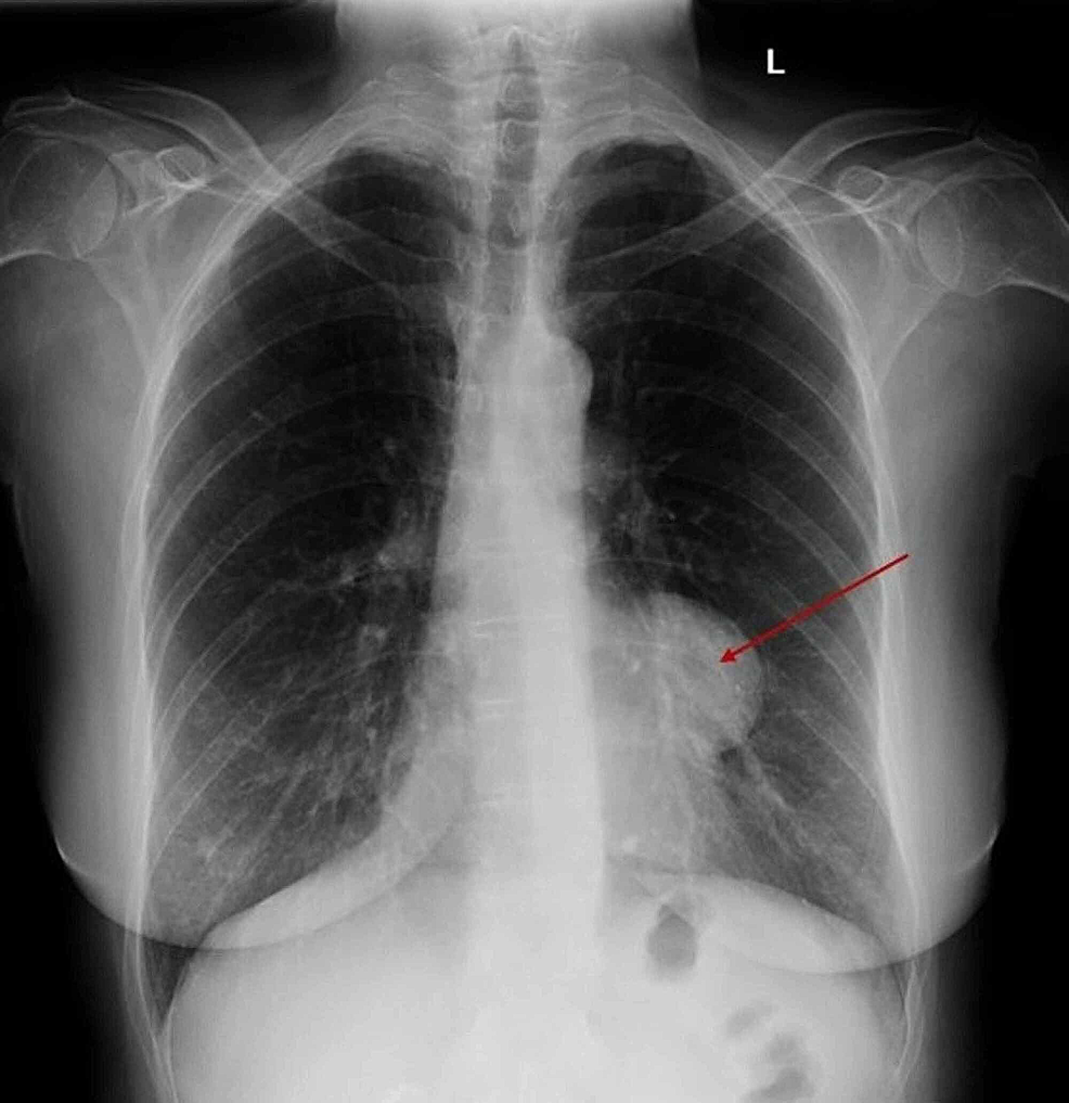 Cureus | Thymoma Presenting as a Pleural-Based Mass