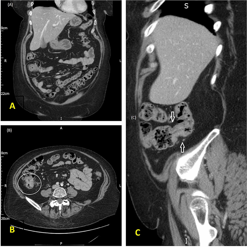 CT-abdomen-(A)-coronal-plane,-(B)-axial-plane,-(C)-sagittal-plane,-there-is-a-focal-spot-of-wall-thickening-in-the-mid-ascending-colon.