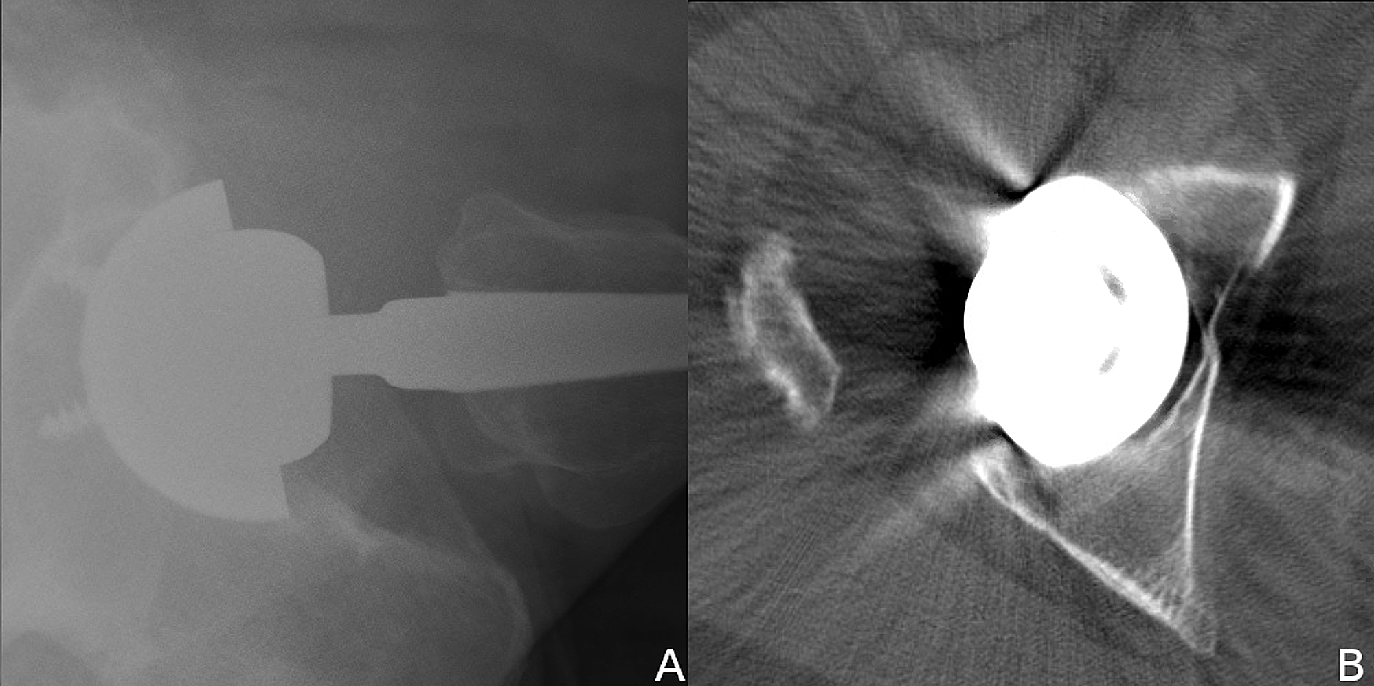 Cureus Surgical Management Of Iliopsoas Impingement With Combined Acetabular Revision And 