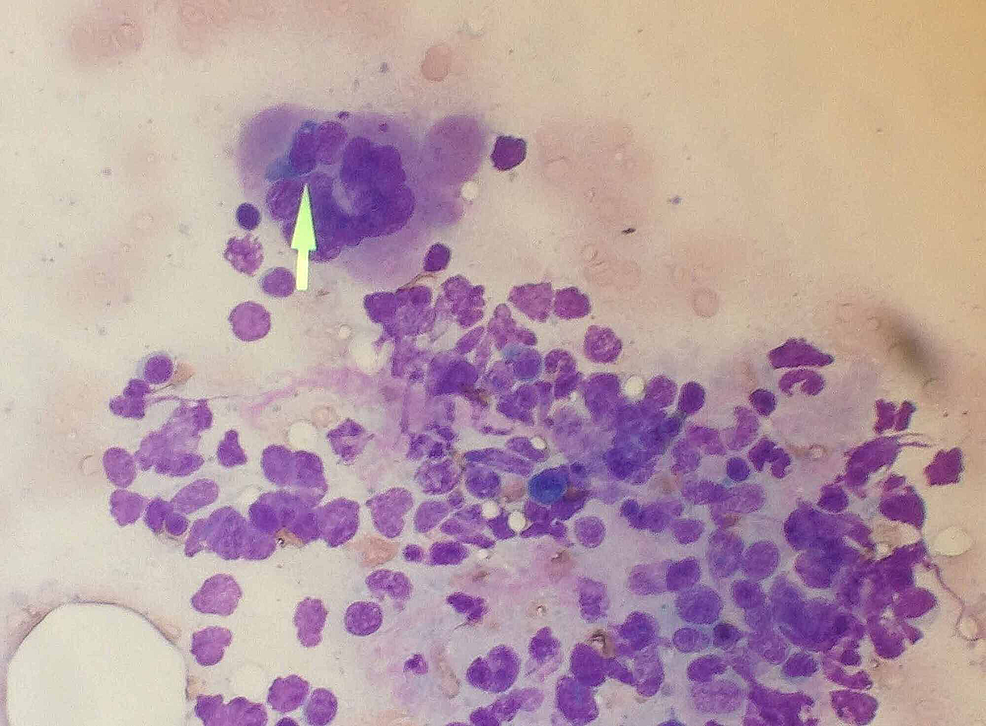 Bone-marrow-biopsy-depicting-histiocytic-cell-in-the-process-of-phagocytosis-of-an-erythroid-precursor-cell.
