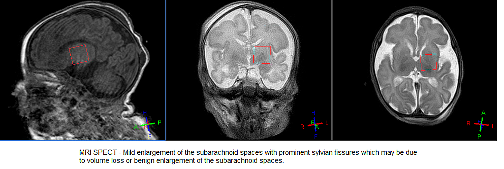 Cureus | A Rare Case of Lethal Neonatal Rigidity and Multi-Focal ...