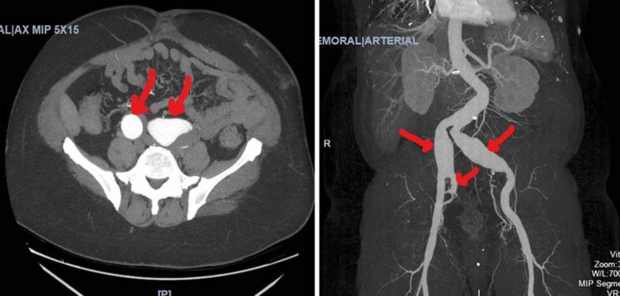 Right Internal Iliac Artery