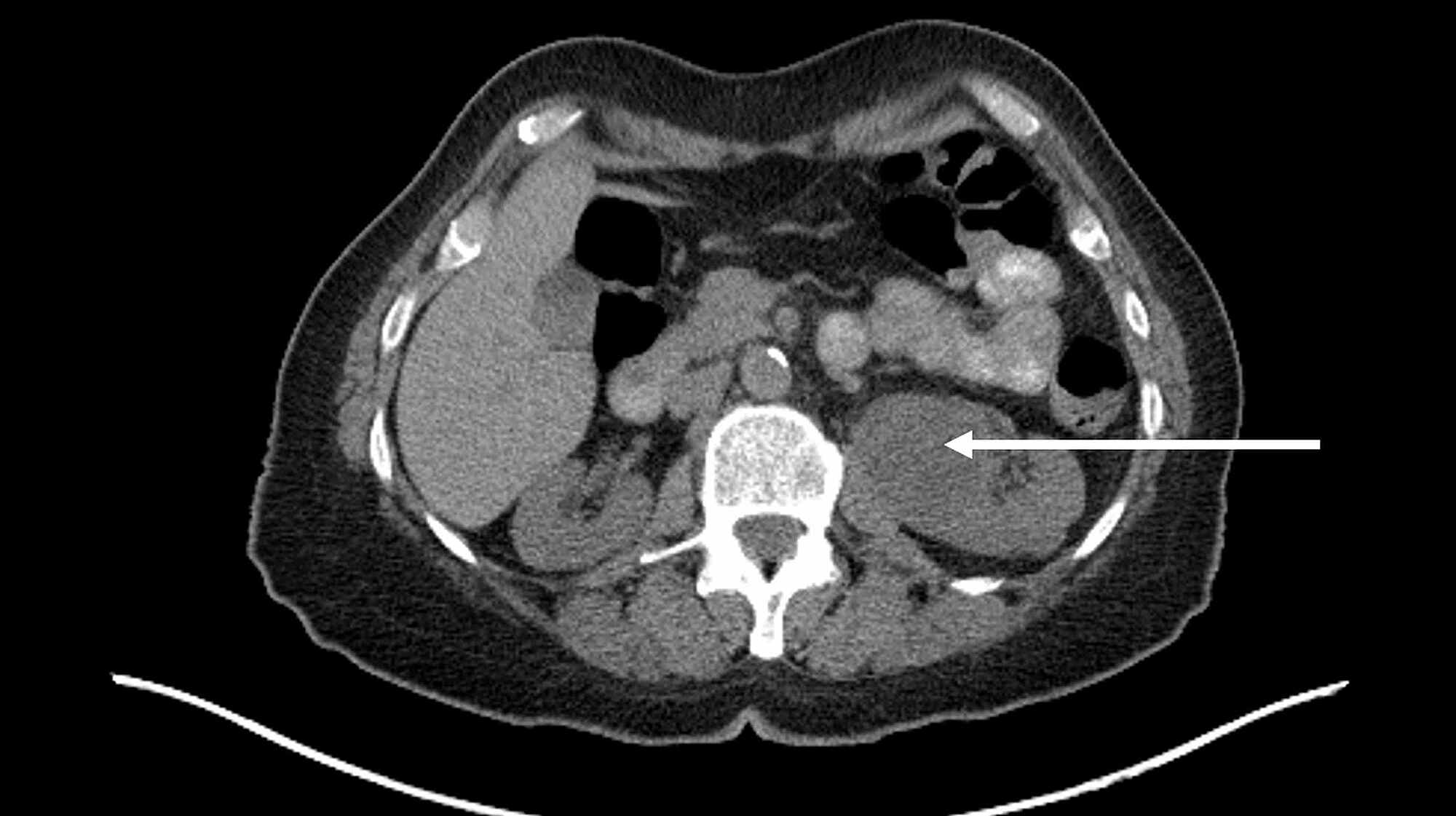 Cureus Plasma Cell Myeloma Within A Renal Cell Carcinoma An Intimate