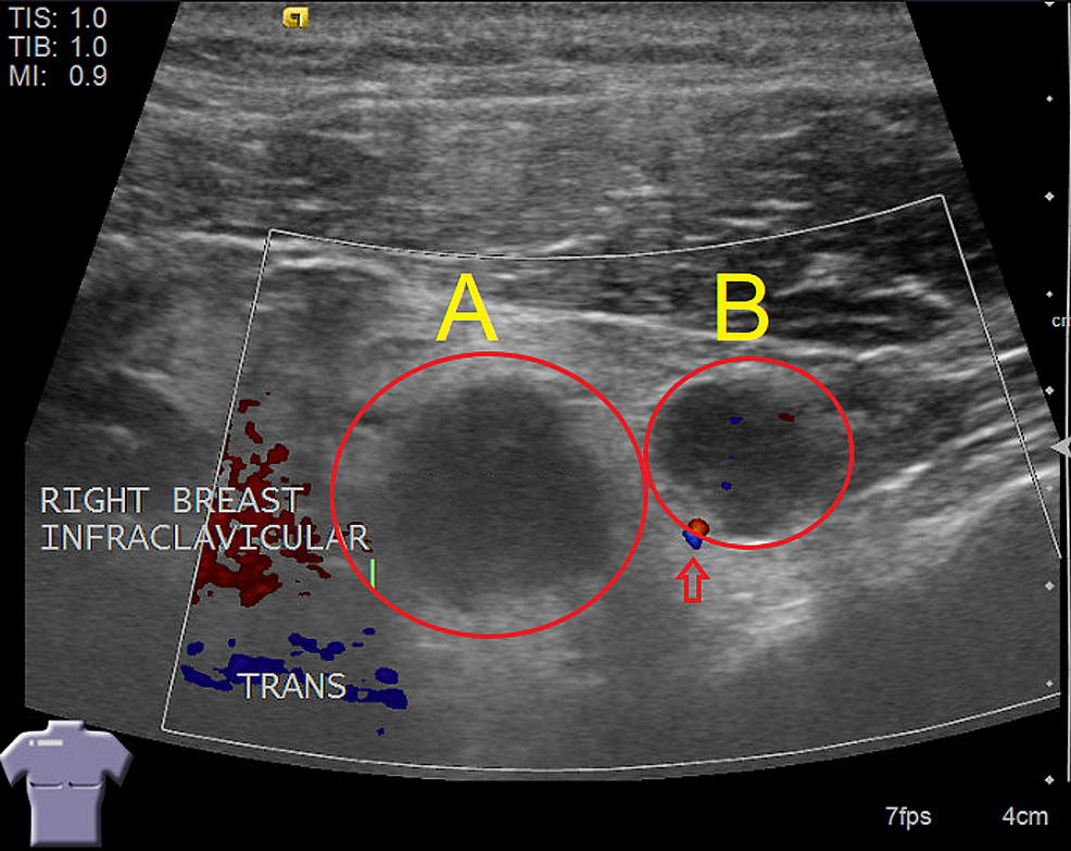 Lymph Node Vs Abscess Ultrasound