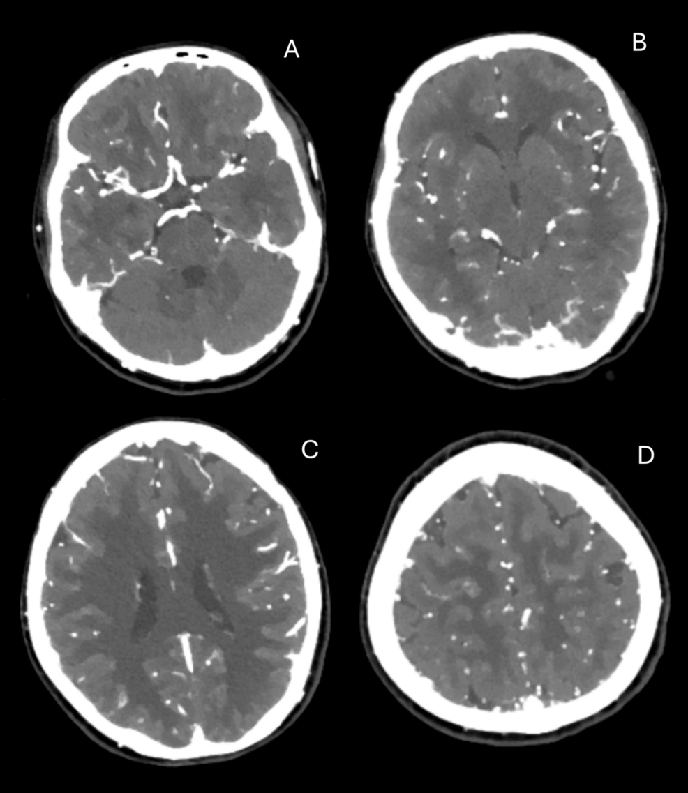 CT-head-and-neck-angiogram