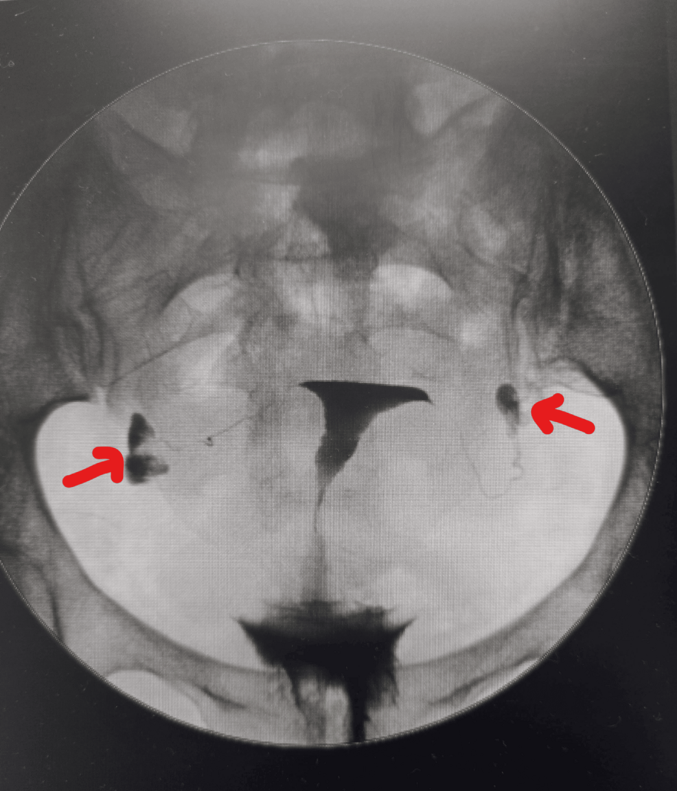 Natural Conception After Tubal Reconstruction: A Rare Success Following Bilateral Fimbrioplasty for Post-pelvic Inflammatory Disease Occlusion