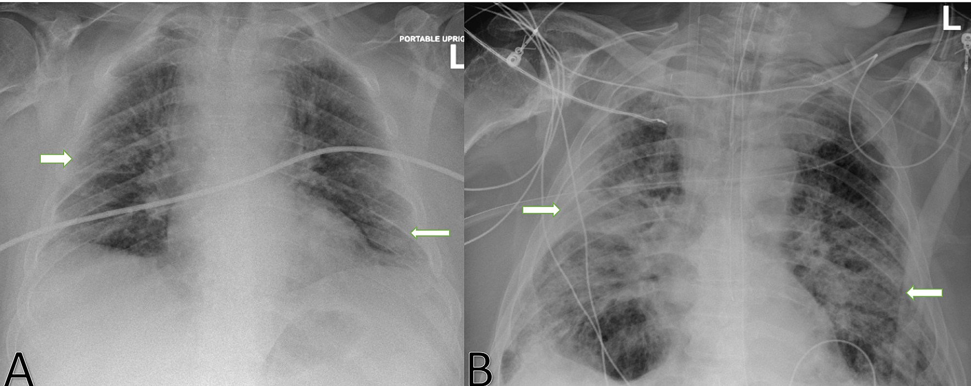 Aspergillosis Chest X Ray