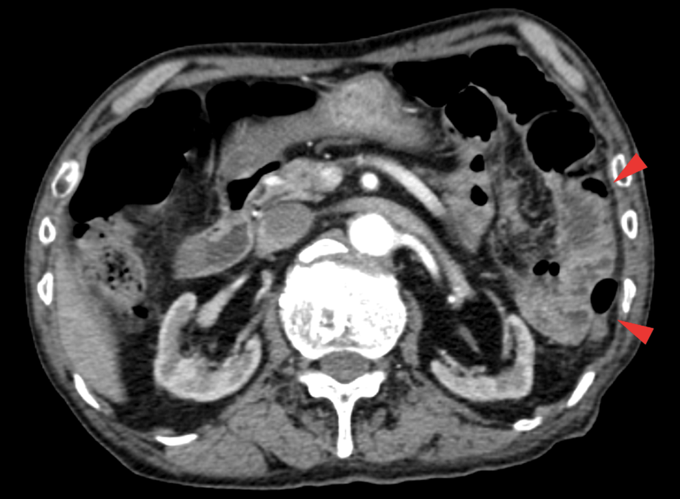 Abdominal and Back Pain Initially Suspected to Be Transient Intestinal Ischemia in a Case of Streptococcus dysgalactiae subsp. equisimilis Bacteremia
