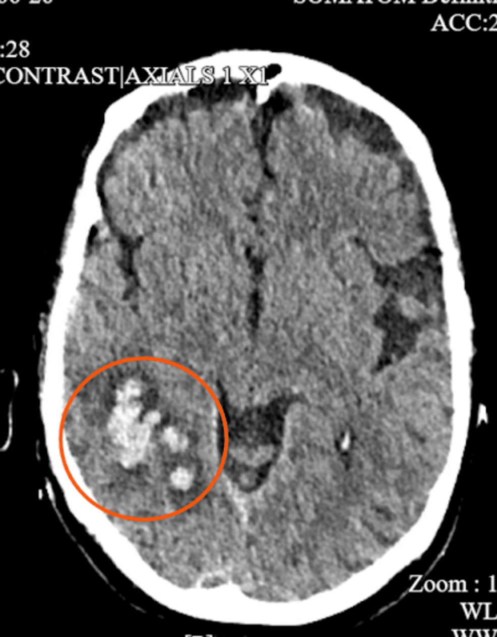 Intracerebral Hemorrhage With Superimposed Psychiatric Illness: Navigating the Evaluation of Altered Mental Status