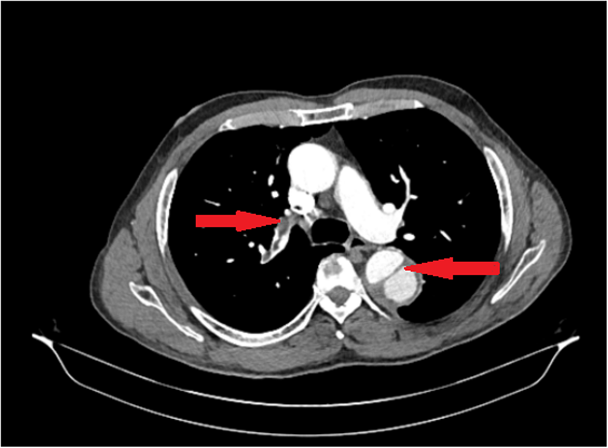 Cureus | Simultaneous Aortic Dissection and Pulmonary Embolism: A ...