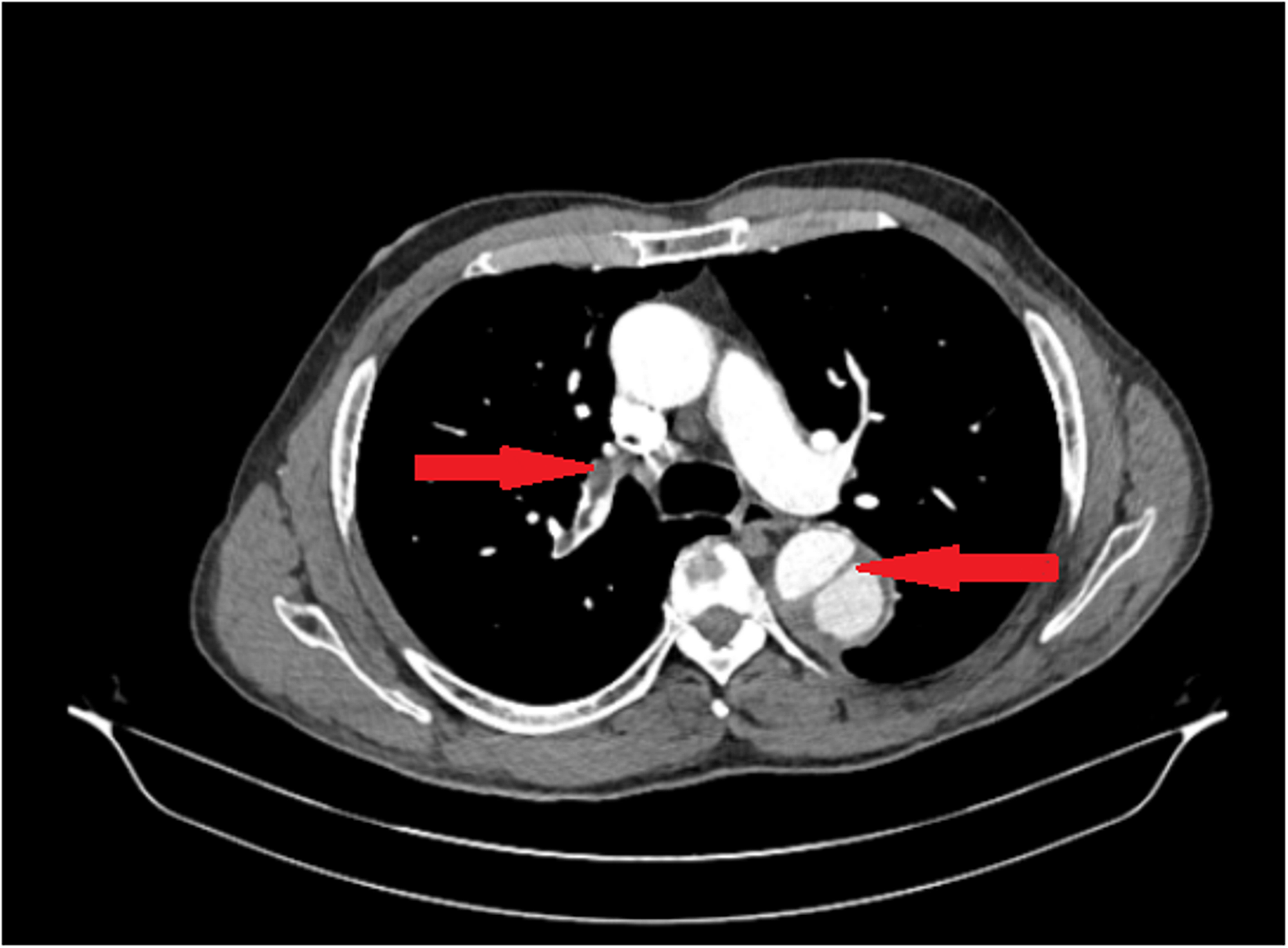 Ct Scan Aortic Dissection Longitudinal View Doccheck Vrogue Co