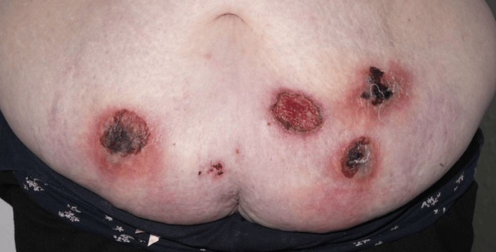 Pyoderma Gangrenosum Secondary to Melanotan