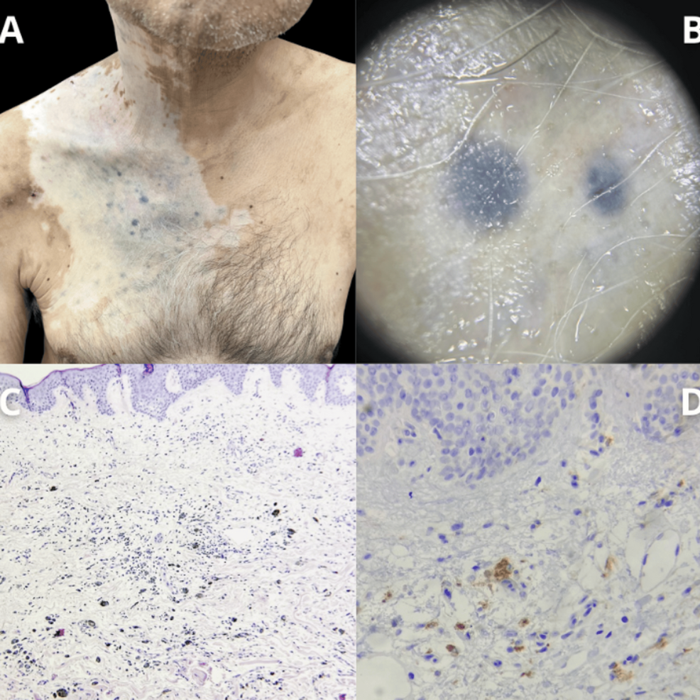 Tumoral Melanosis: A Benign Mimicker of Malignant Disease
