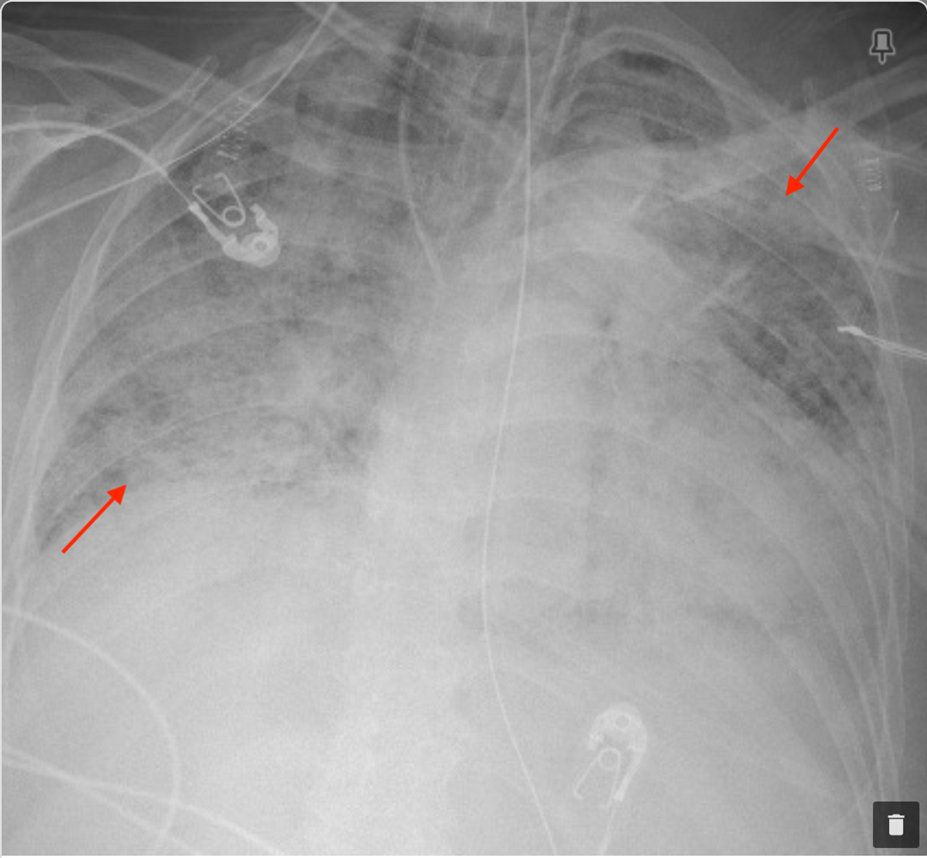 Cureus Life Threatening Diffuse Alveolar Hemorrhage As An Initial Presentation Of Microscopic Polyangiitis Covid 19 As A Likely Culprit