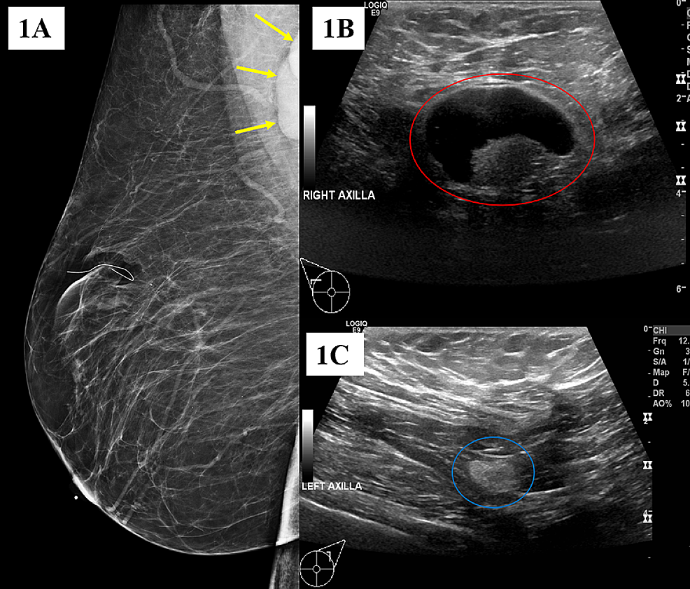 Granulomatous diseases of the breast and axilla: radiological findings with  pathological correlation, Insights into Imaging