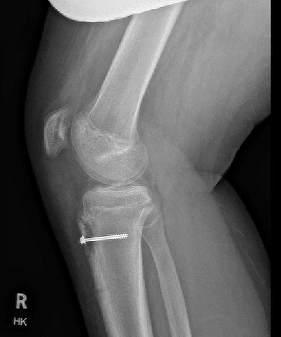 Cureus | Osgood-Schlatter Disease as a Possible Cause of Tibial ...