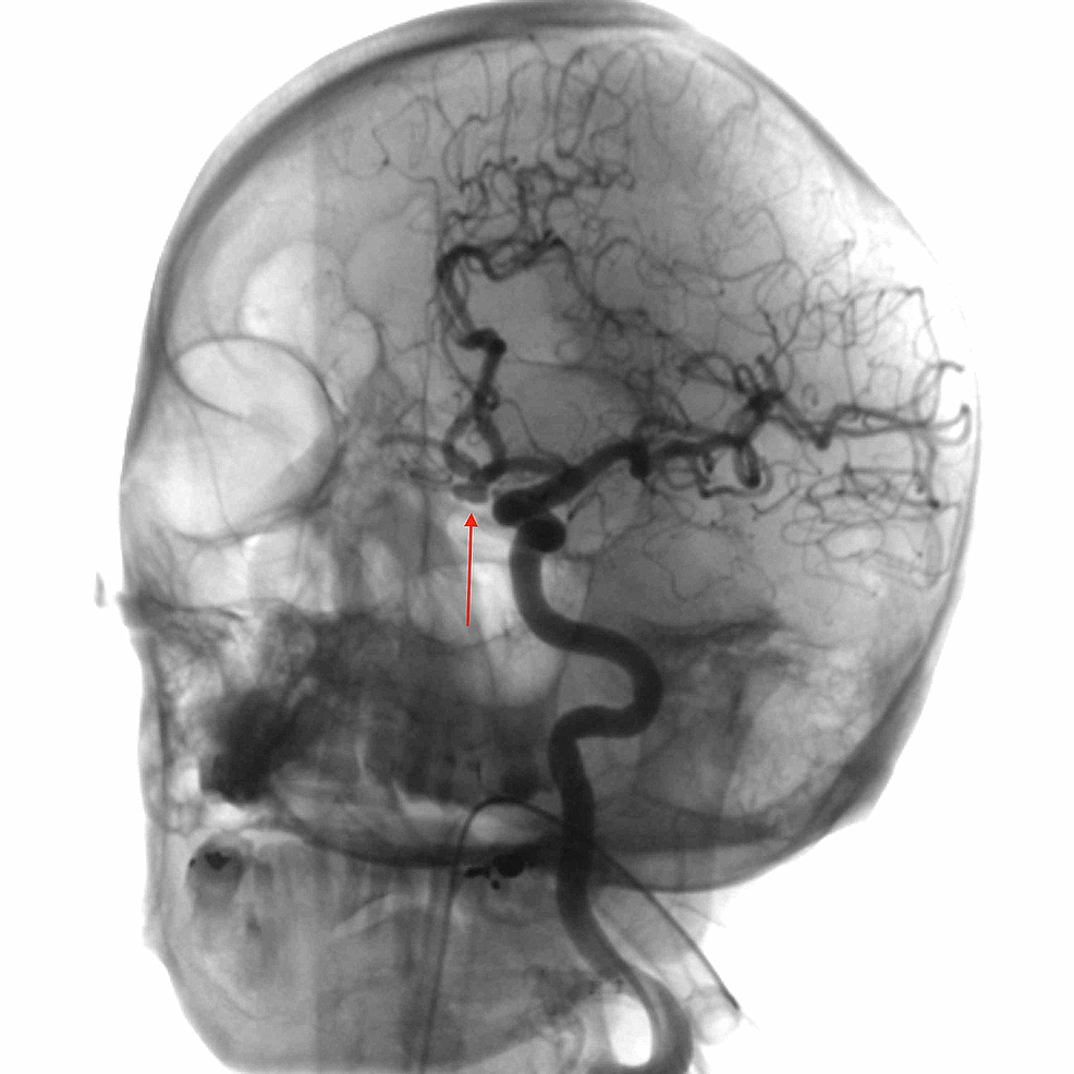 Ultrasound Findings Of Vertebral Artery Dissection Do Vrogue Co