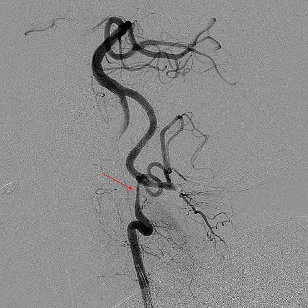 Cureus Vertebral Artery Dissection A Pain In The Neck