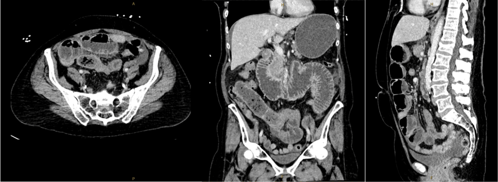 semaglutide and intestinal obstruction A Case Report of Bezoar-Induced Small Bowel Obstruction: A Potential  Surgical Complication of Semaglutide