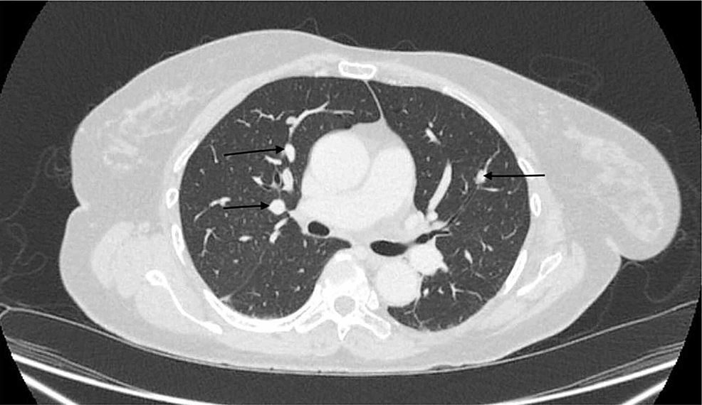 Computed-tomography-of-chest-showing-multiple-pulmonary-nodules-(black-arrows)-prior-to-starting-everolimus-10mg-PO.