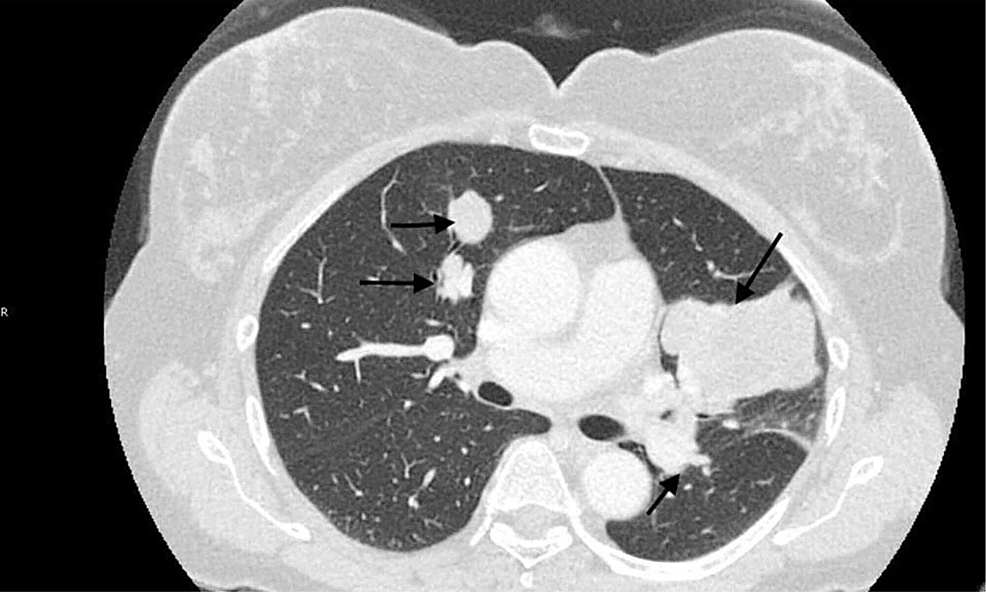 Computed-tomography-of-the-chest-showing-a-significant-progression-of-disease-in-lungs-(black-arrow)-two-months-after-starting-everolimus-and-prior-to-starting-nab-sirolimus.
