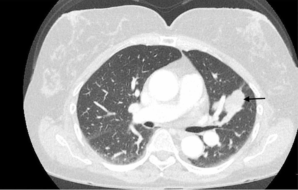Computed-tomography-of-chest-showing-a-decrease-in-size-of-pulmonary-nodules-(black-arrow)-three-months-after-starting-nab-sirolimus.