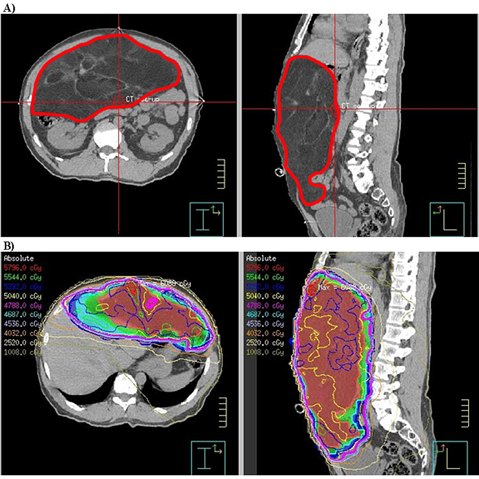 Cureus | Long-Term Quality of Life of Retroperitoneal Sarcoma Patients