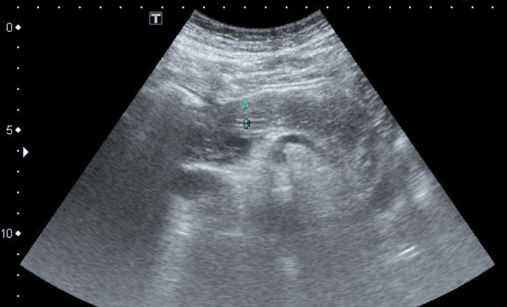 Acute Pancreatitis Associated With Semaglutide in a Patient With  Multimorbidity: A Case Report