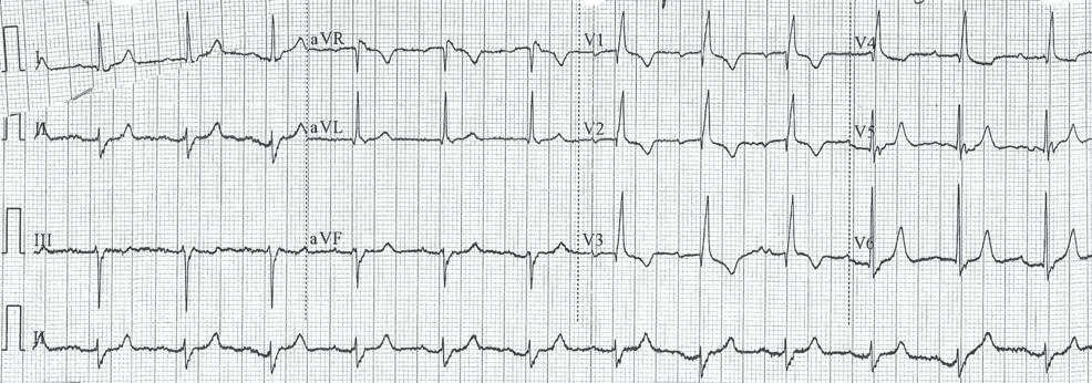 Right Atrial Perforation With Pericardial Effusion and Visceral Pericardial Flap Observed During Pacemaker Implantation: An Echocardiographic Case Report