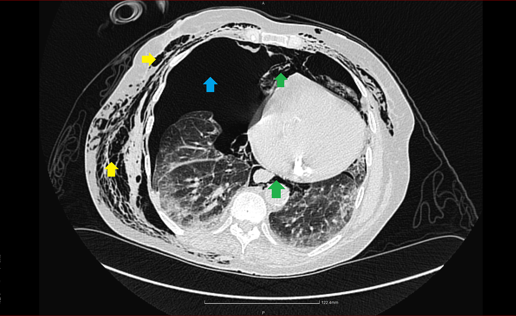 Cureus A Case of Tension Pneumothorax After Diverticular Rupture