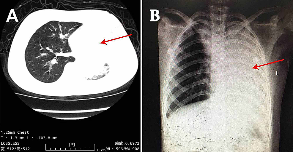 Primary-Chest-Computerized-Tomography-and-Chest-Radiograph