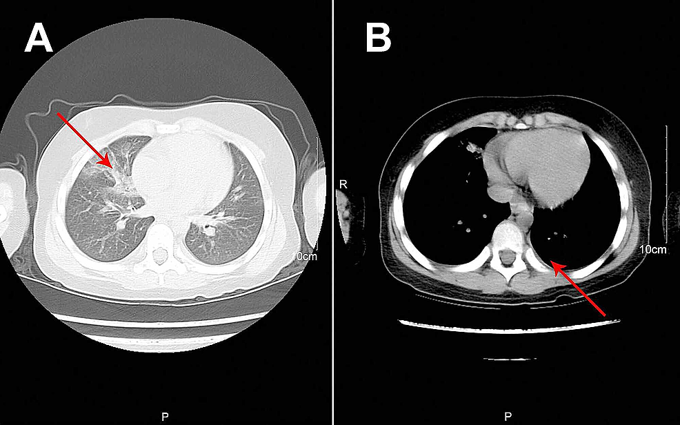 Reexamination-of-Chest-Computerized-Tomography