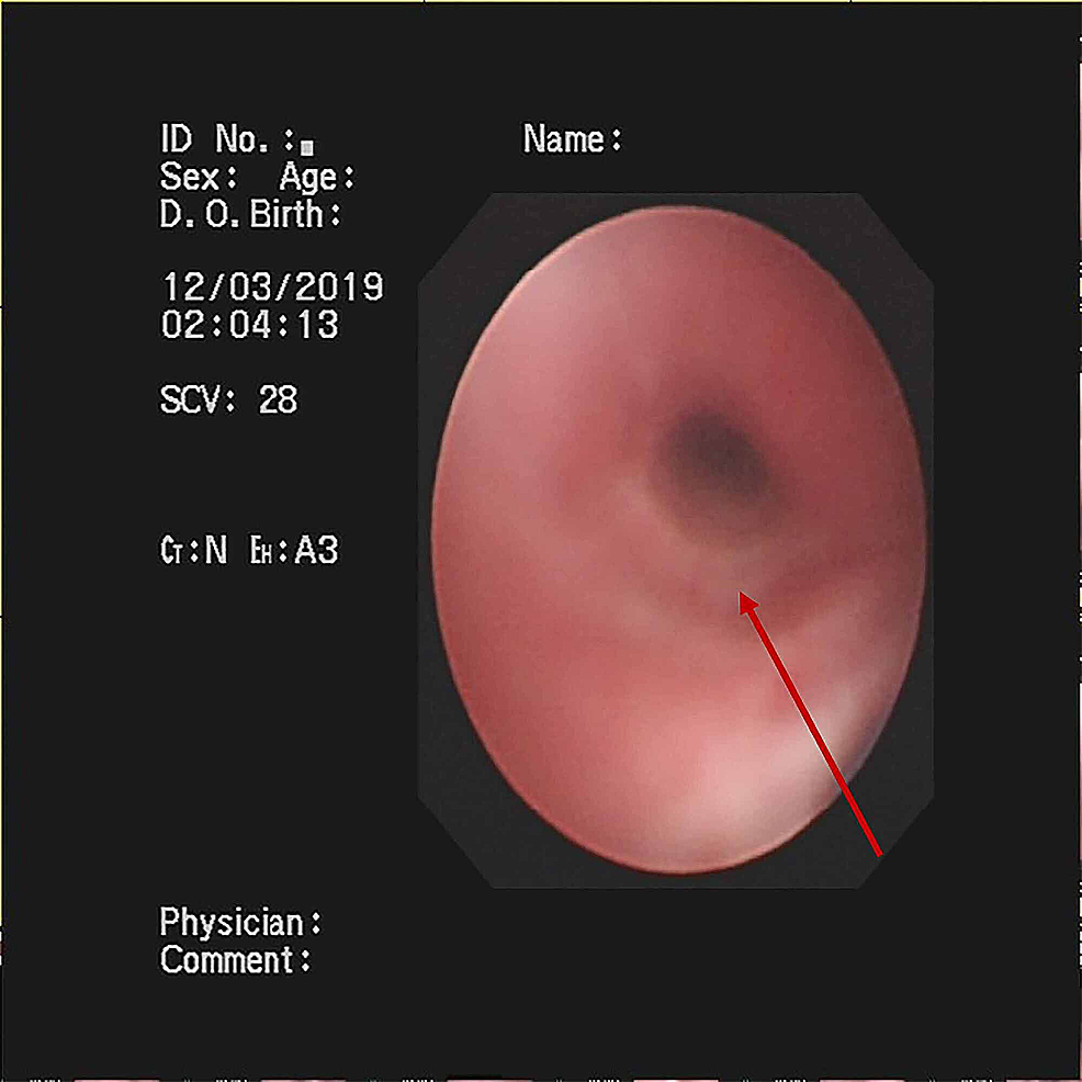 Findings-of-Fiberoptic-Bronchoscopy