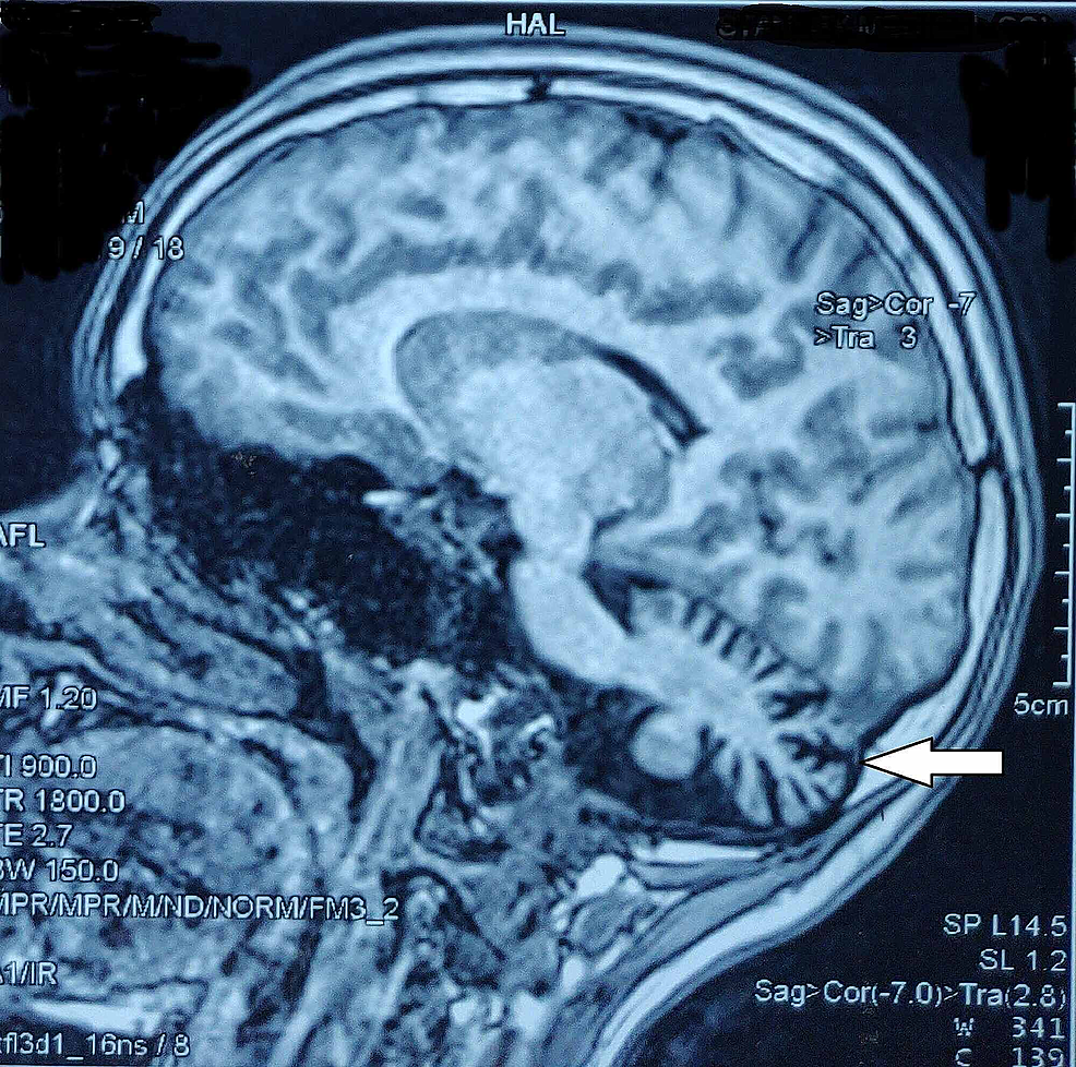 Cerebellar-atrophy-on-MRI-of-the-brain-(arrow)